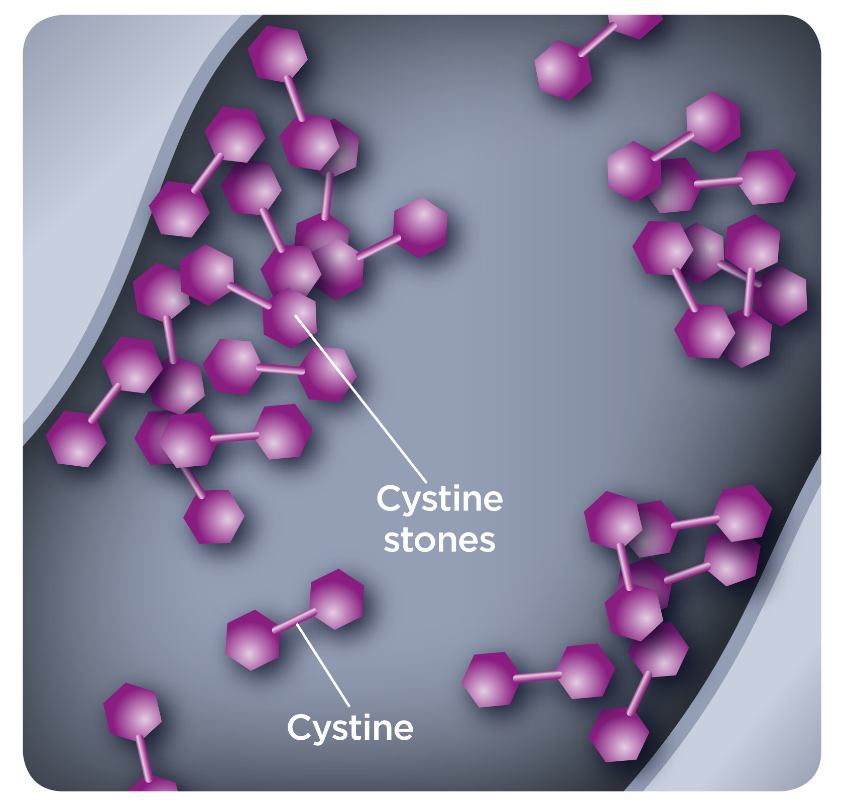 cystinuria stone